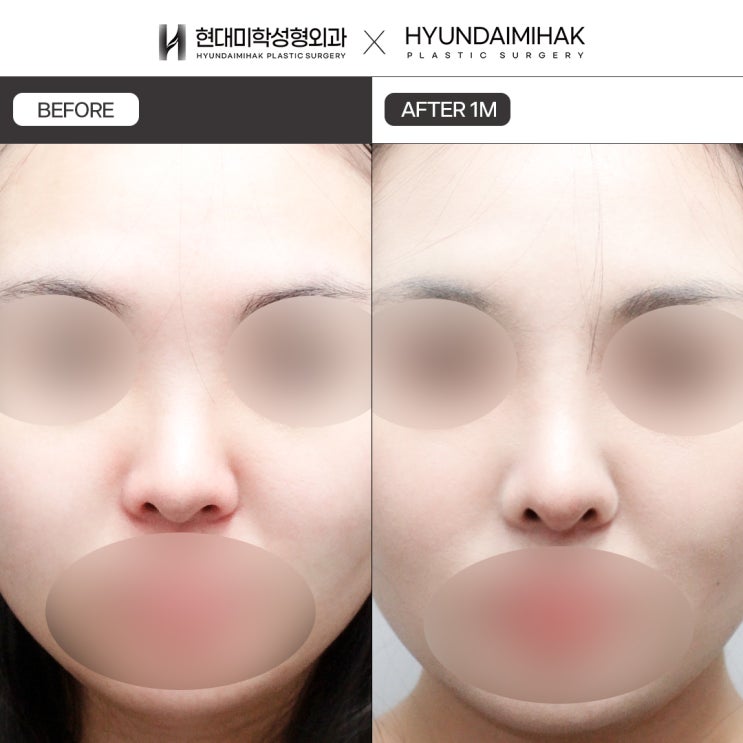 ปรับไลน์ผนังกั้นจมูกสำหรับจมูกสั้นให้ดูมีมิติมากขึ้น