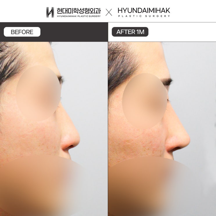 รีวิวแก้จมูกผู้ชาย กรณีไม่พอใจรูปทรง