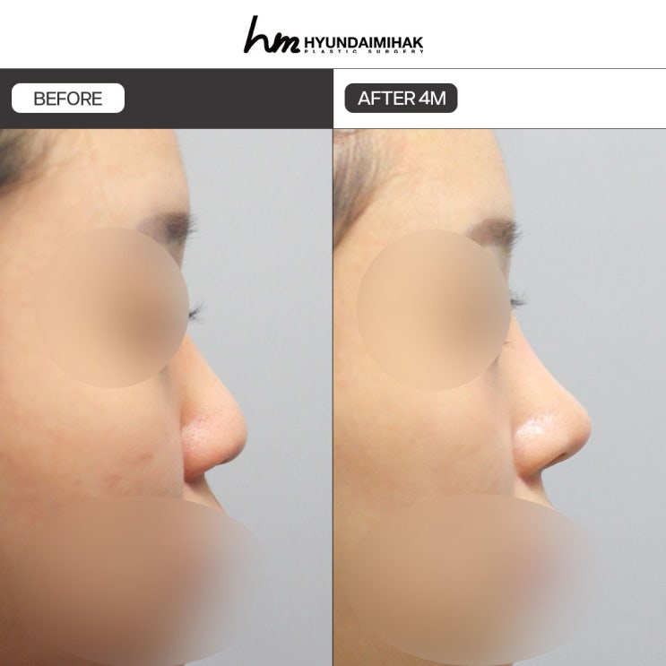 วิธีเลือกวัสดุเสริมจมูก ศัลยกรรมความงาม Hyundai จะอธิบายให้ทราบ