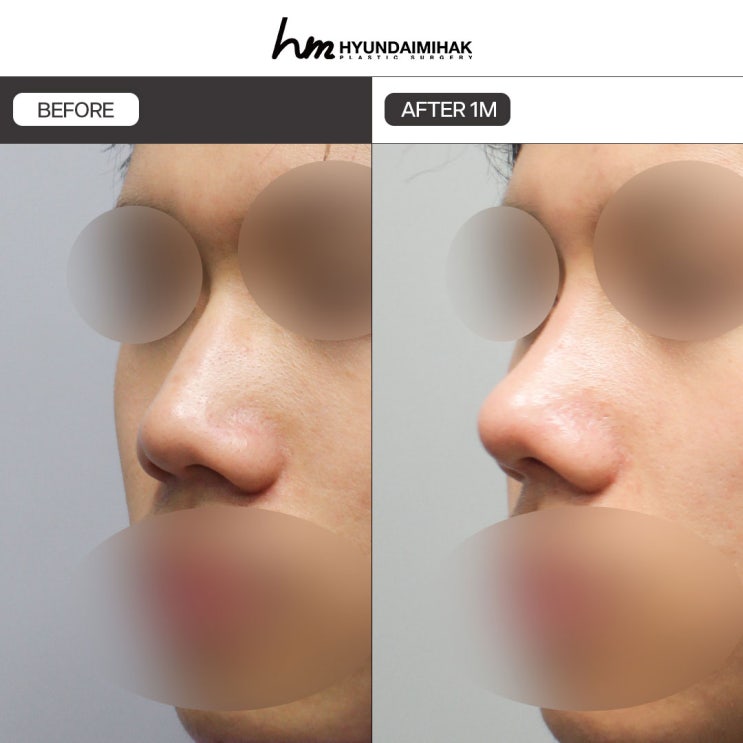 รีวิวศัลยกรรมผู้ชาย อัตราความสำเร็จในการนัดบอดอาจเปลี่ยนไป