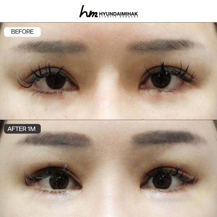 รีวิวแก้ไขกล้ามเนื้อตา ลบภาพลักษณ์ง่วงนอนได้อย่างรวดเร็ว