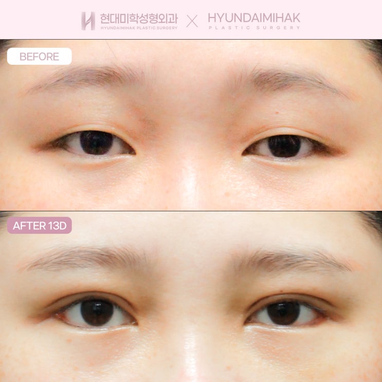 ก่อนและหลังผ่าตัดเปิดหัวตา หากกังวลเรื่องชั้นพับมองโกเลียน