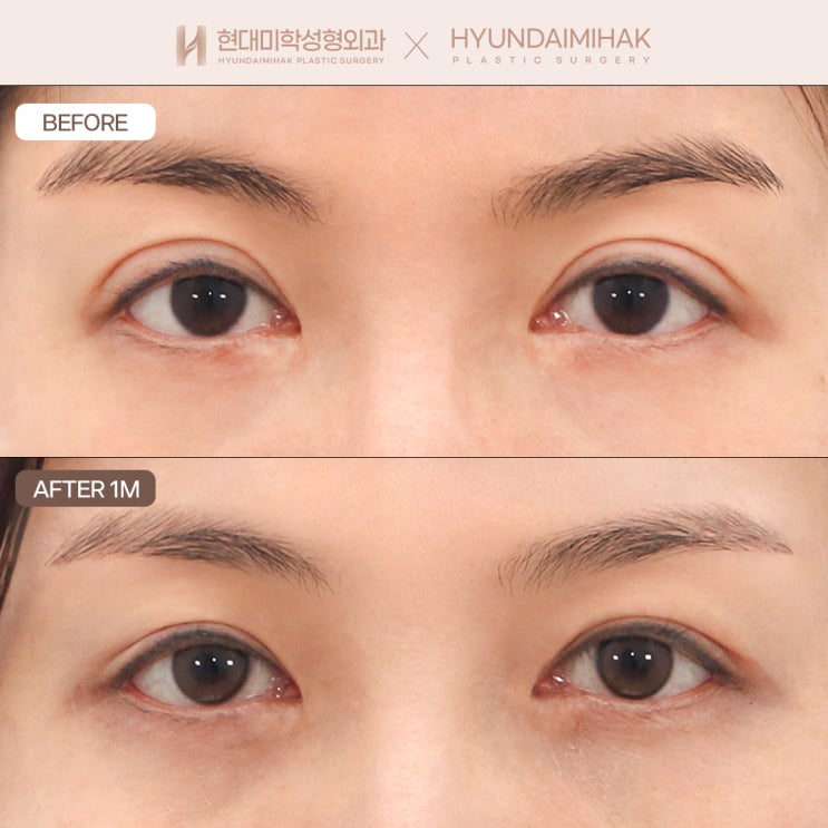 ปรับลดชั้นตาสองชั้น เพื่อดวงตาที่ดูเป็นธรรมชาติมากขึ้น