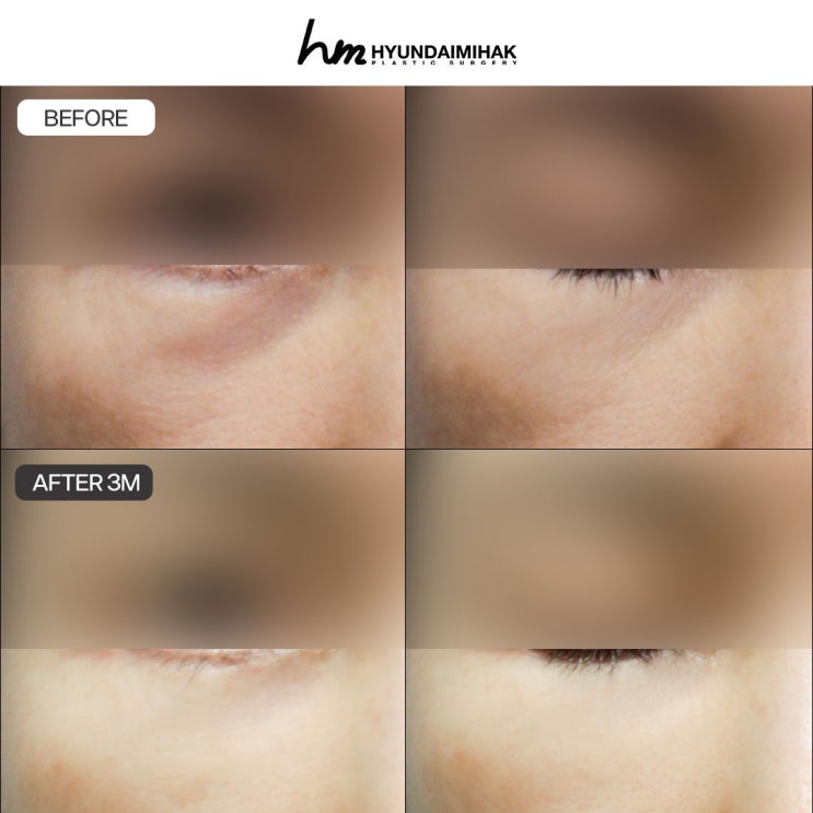 ค่าใช้จ่ายผ่าตัดถุงใต้ตา: เกณฑ์ในการเลือกโรงพยาบาลที่มีประสบการณ์