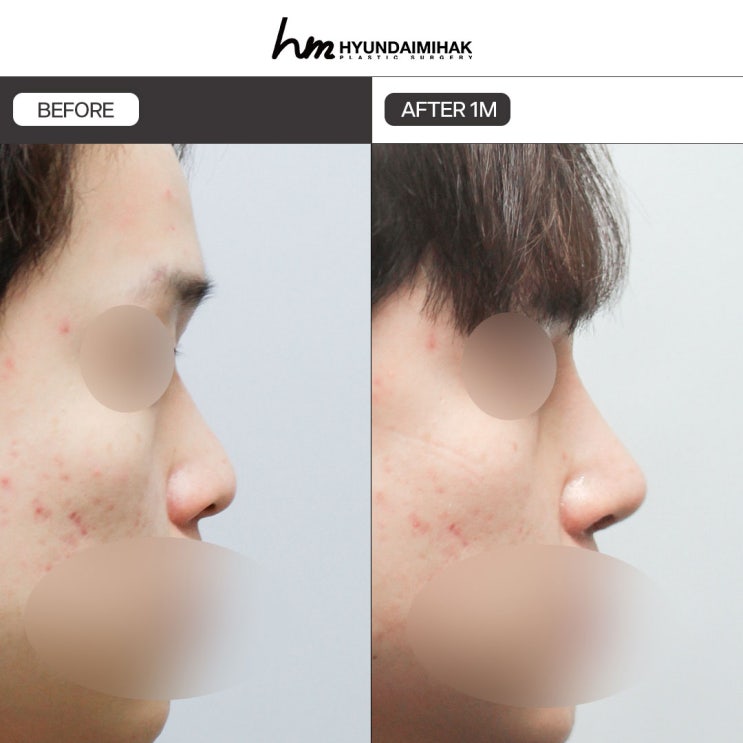 ศัลยกรรมจมูกผู้ชายแตกต่างอย่างไร และควรเลือกอย่างไร