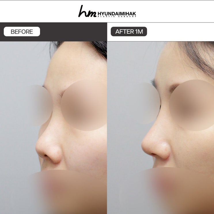 ศัลยกรรมแก้จมูกเชิด วิธีสร้างภาพลักษณ์ที่ดู refined และมีมิติ