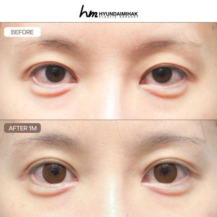เทคนิคความเชี่ยวชาญในการแก้ไขดวงตาที่ล้มเหลวจากการทำศัลยกรรมตา