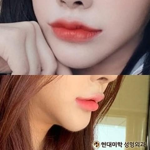 รีวิวผ่าตัดยกมุมปาก เปลี่ยนเป็นภาพลักษณ์ที่สดใส