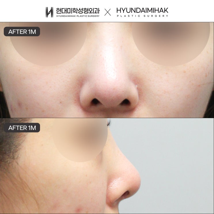 ศัลยกรรมแก้จมูกที่กังนัม: วิเคราะห์สาเหตุความล้มเหลวและปรับแต่งรูปทรงใหม่