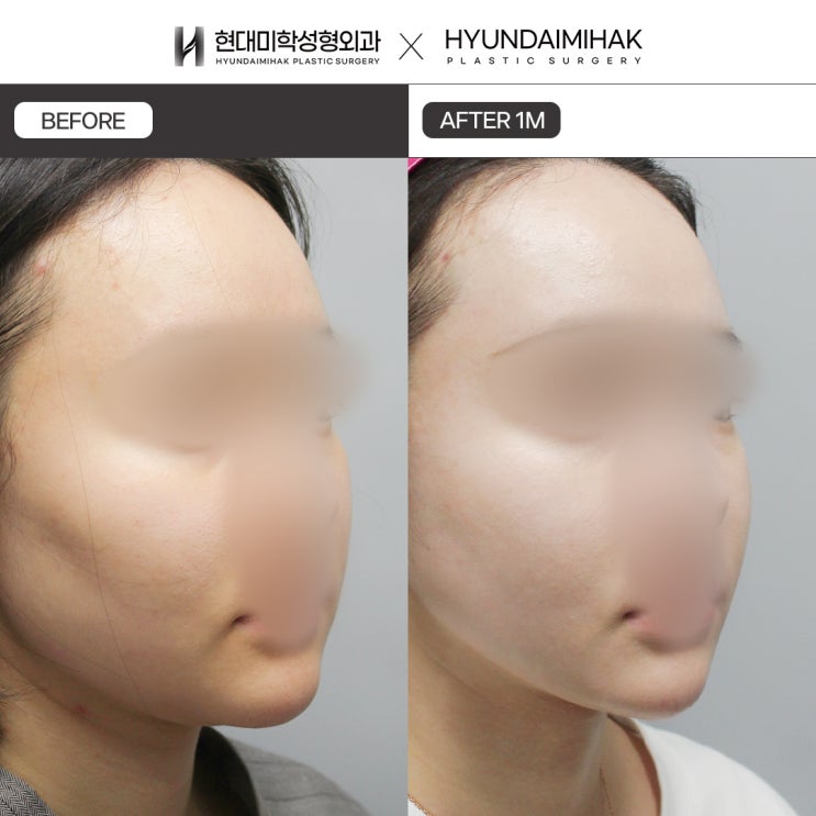 ผ่าตัดลดไขมันใบหน้าอย่างไรไม่ให้หย่อนคล้อยและเป็นแอ่งยุบ