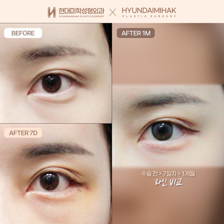 ปรับรูปตาให้ดูเป็นธรรมชาติและอ่อนโยนด้วยการผ่าตัดลดหางตา