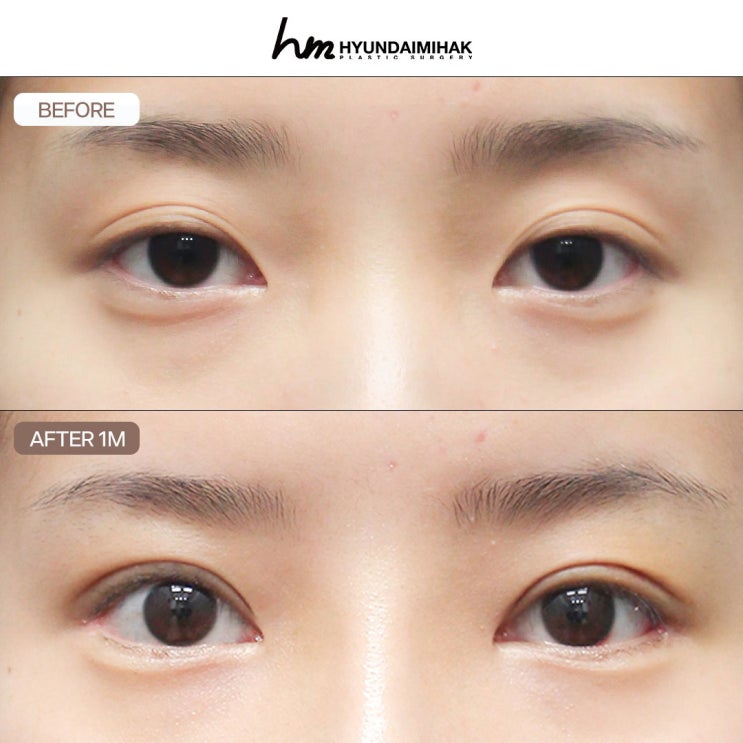 เช็กลิสต์เมื่อต้องไปปรึกษาศัลยกรรม: ตา จมูก ร้อยไหม และดูดไขมัน