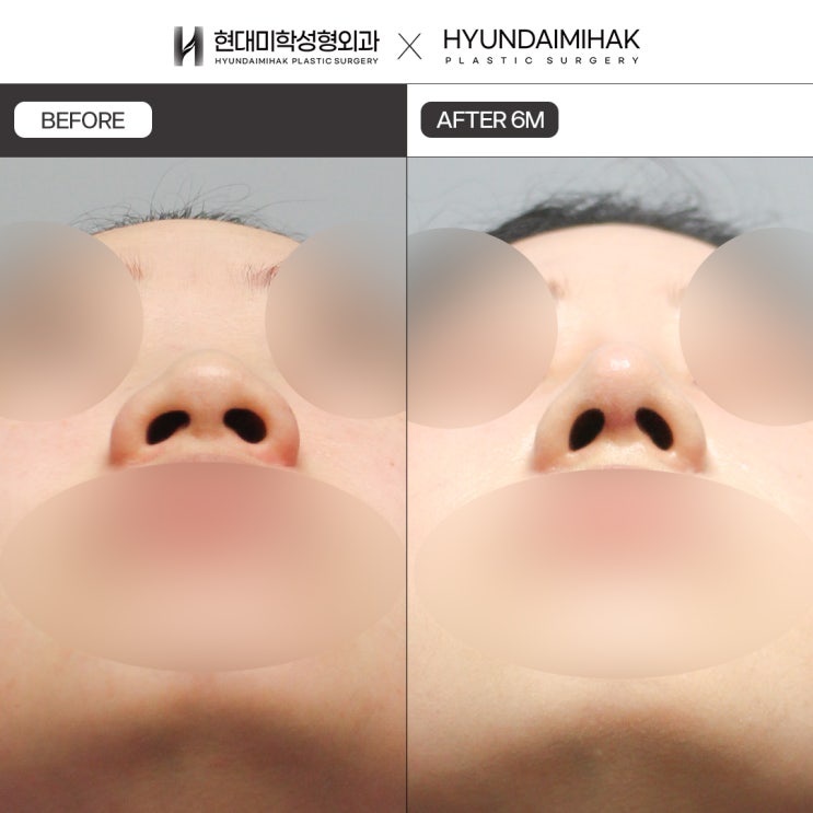 ลดปีกจมูกให้สัดส่วนและพื้นที่ดูสมดุล