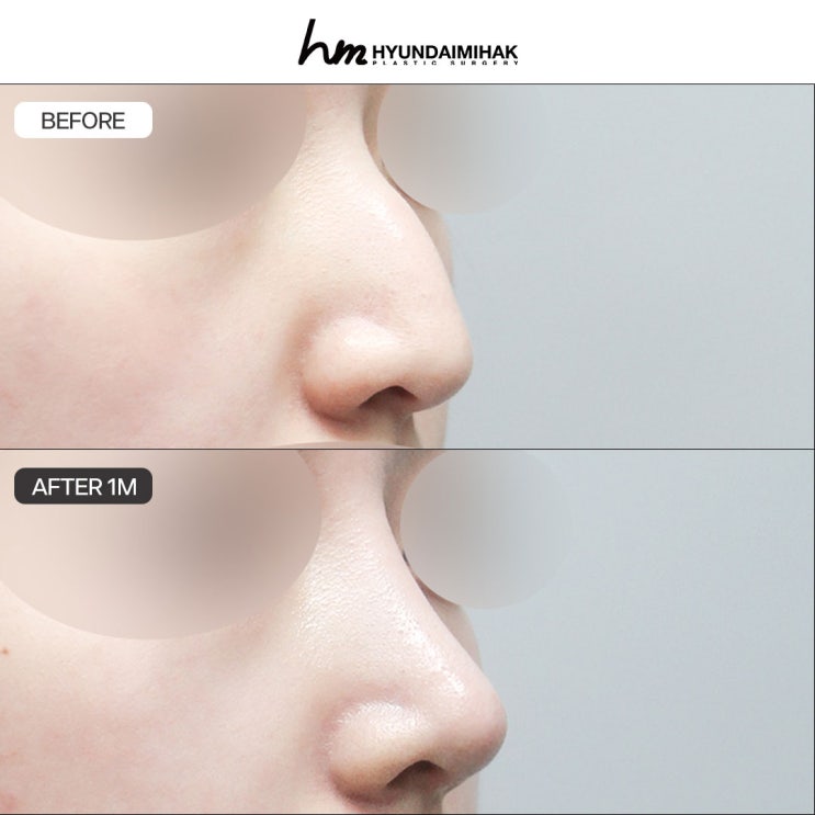 รีวิวผ่าตัดแก้จมูกฮัมพ์: เคสความสำเร็จที่ศัลยกรรมความงาม Hyundai