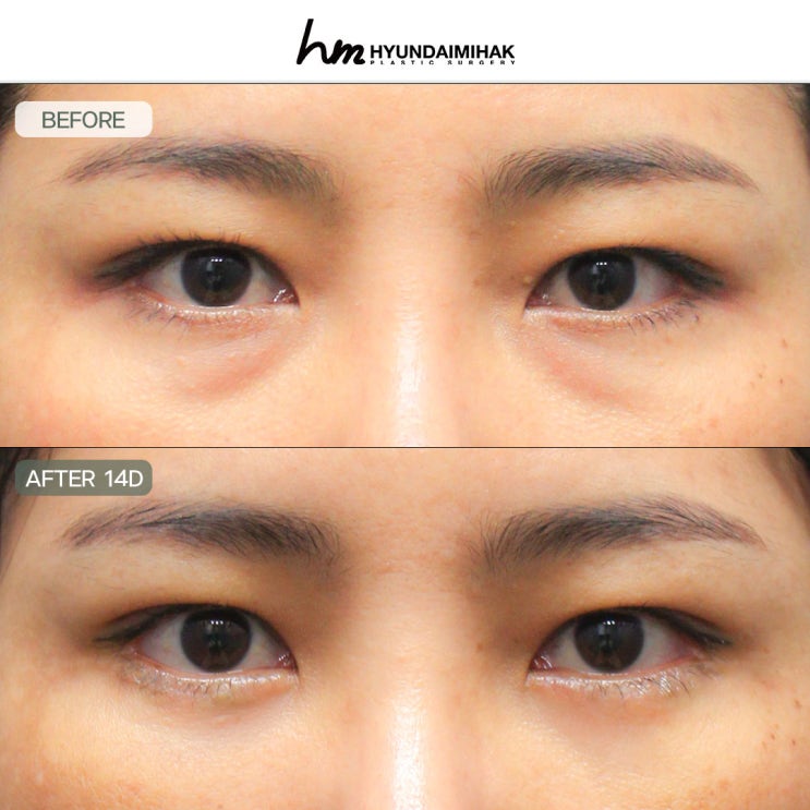 ต้องอ่านก่อนปรึกษาคลินิกแก้ถุงใต้ตา! ดูอ่อนเยาว์ขึ้นโดยไม่เกิดผลข้างเคียง
