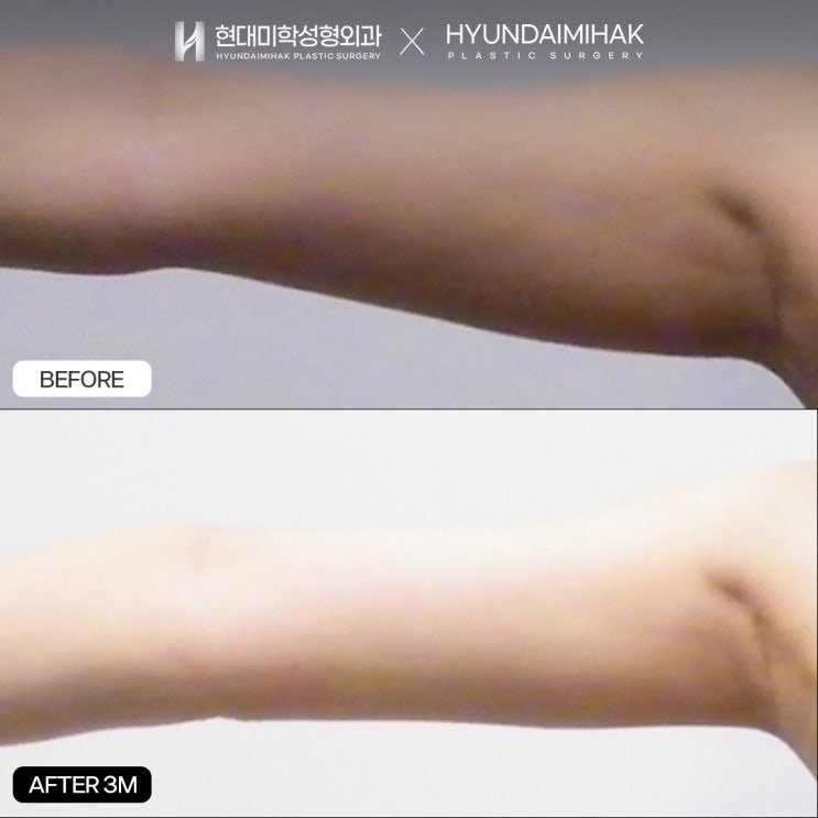 ดูดไขมันมินิบริเวณต้นแขน วิธีสวยขึ้นได้อย่างรวดเร็วและปลอดภัย