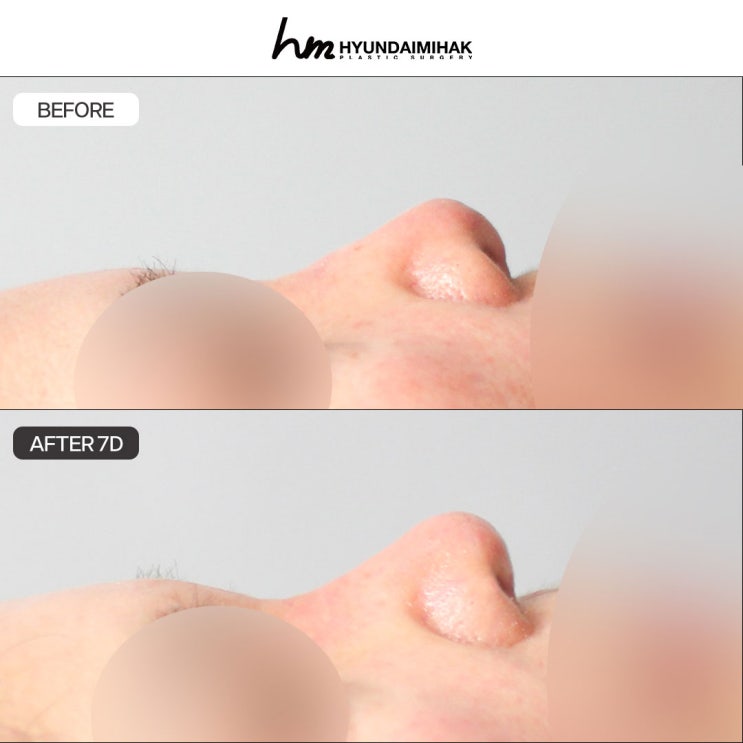 ศัลยกรรมเสริมสร้างจมูก ศัลยกรรมความงาม Hyundai แตกต่าง