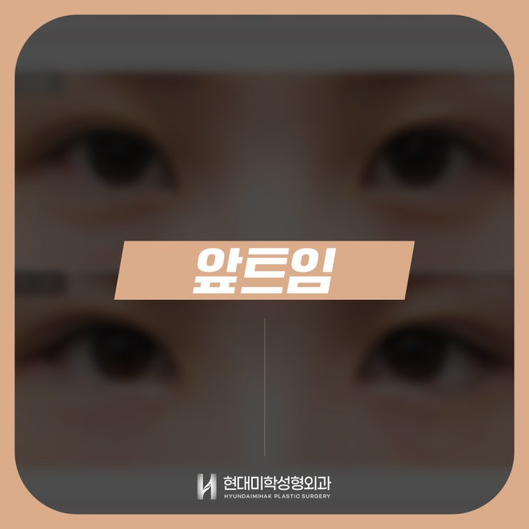 ศัลยกรรมเปิดหัวตา เคล็ดลับของดวงตาที่ดูคมชัดและเป็นธรรมชาติ