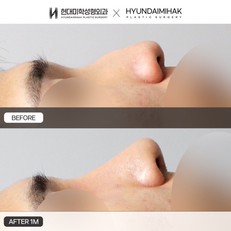 การแก้จมูกฮัมพ์ในผู้ชาย เพื่อปรับปรุงสันจมูกนูน