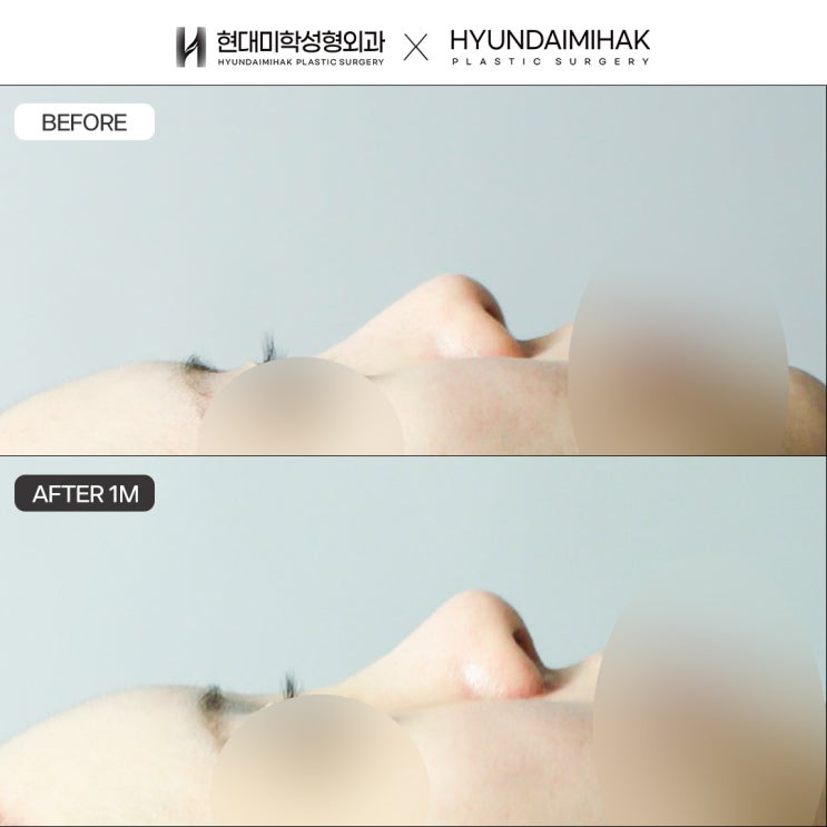 จมูกทรงตรงสำหรับผู้หญิง ทำอย่างไรให้ได้จมูกที่รับกับใบหน้า