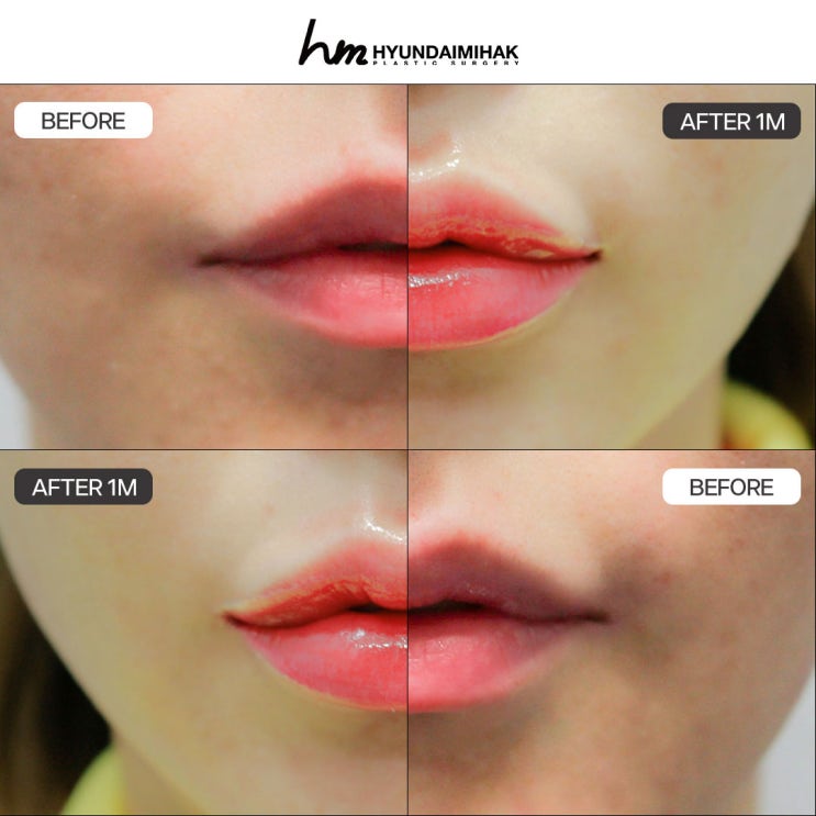 รีวิวศัลยกรรมริมฝีปาก เปลี่ยนจากใบหน้าดูนิ่งขรึมให้เป็นลุคที่น่าประทับใจ