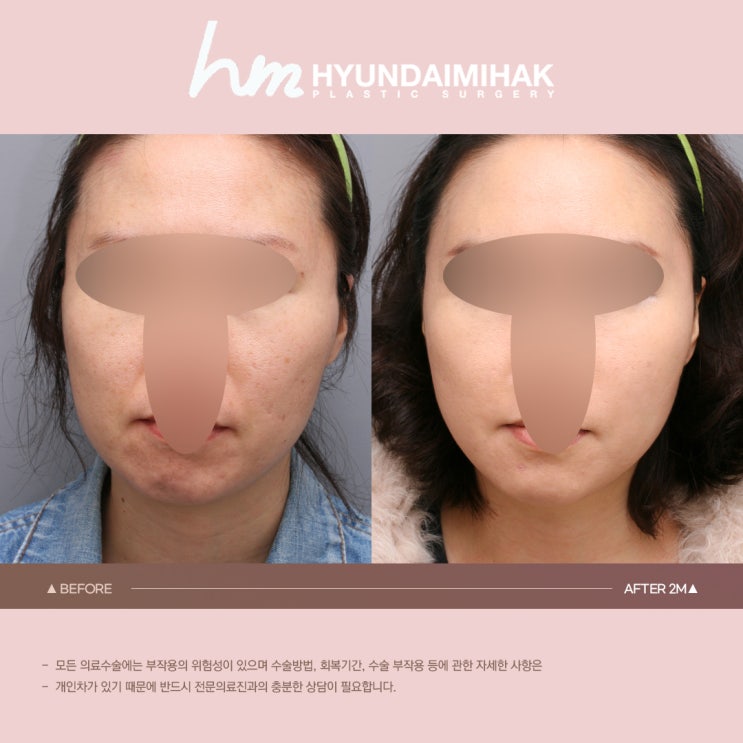 การยกกระชับวัยกลางคน รักษาความอ่อนเยาว์แม้หลังวัย 50