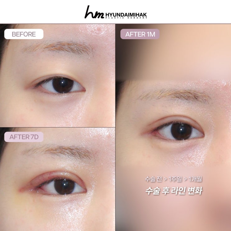 รีวิวเปิดหัวตาและหางตาแบบดูอัล วิธีเปลี่ยนดวงตาเล็กและดูอึดอัดให้ชัดเจนขึ้น
