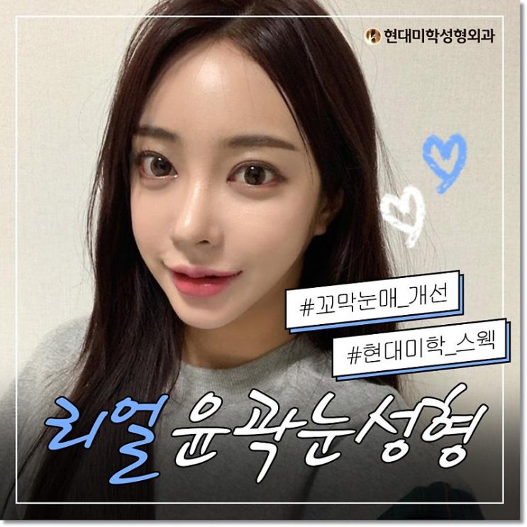 ศัลยกรรมตาสองชั้นพร้อมแก้กล้ามเนื้อตาช่วยให้ดวงตาคมชัด จนรู้สึกประทับใจ