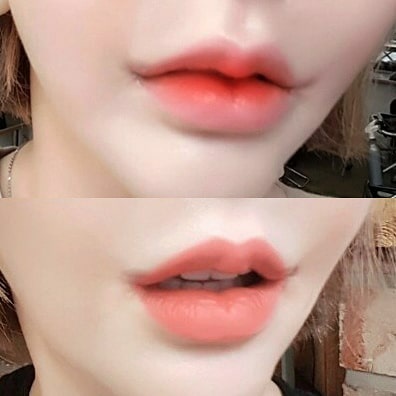คลายความกังวลด้วยการผ่าตัดร่องเหนือริมฝีปาก
