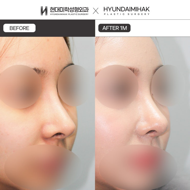 โรงพยาบาลที่เชี่ยวชาญการแก้จมูก ทำให้จมูกที่ดูแข็งเป็นธรรมชาติ