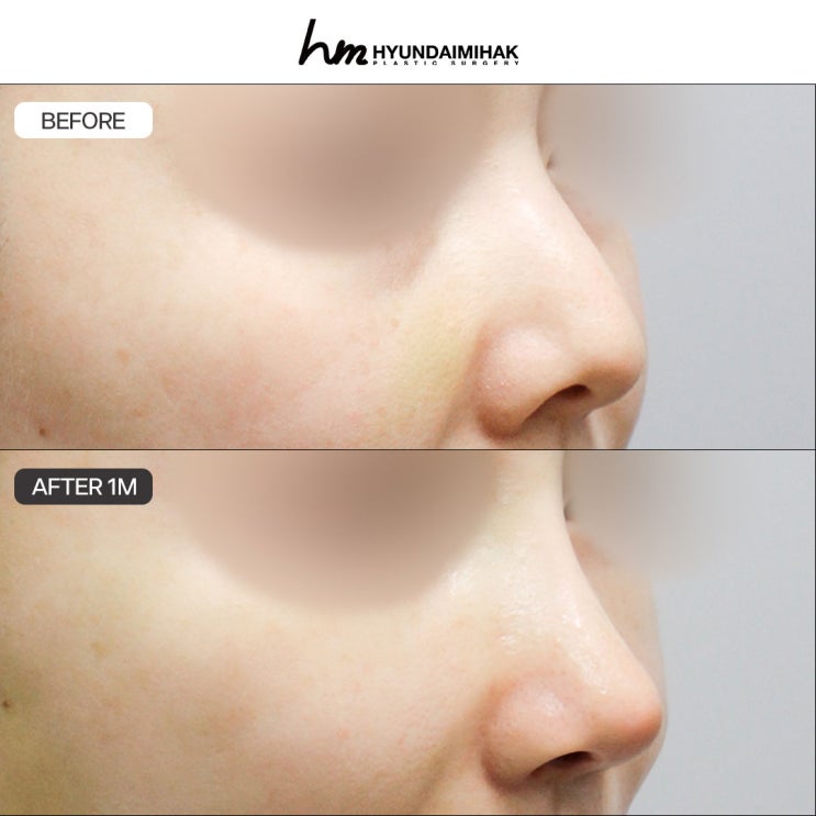 ศัลยกรรมความงาม Hyundai ที่สะท้อนเทรนด์ศัลยกรรมจมูกทรงหรูโดดเด่น