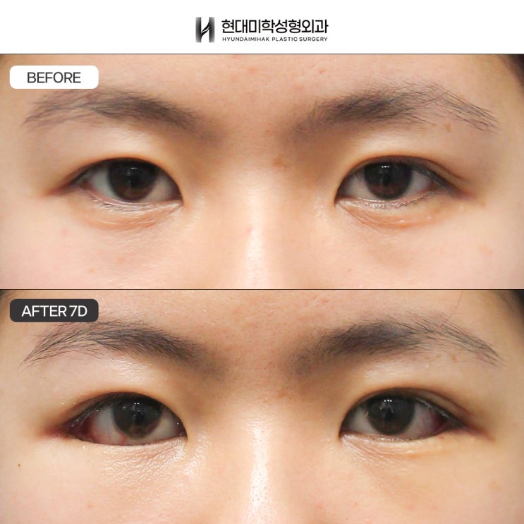 การเปรียบเทียบก่อนและหลังเปิดหางตา ที่ได้ผลดีกับรูปตาที่มีความยาวแนวนอนสั้น