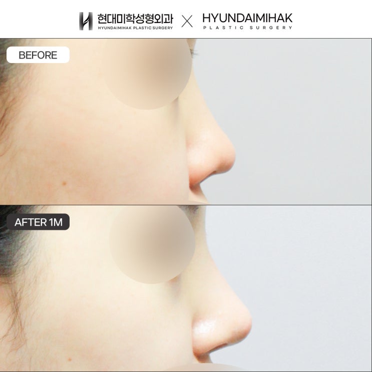 ศัลยกรรมปลายจมูกทรงชมพู่ วิธีแก้ปัญหาปลายจมูกทู่และดูหนา
