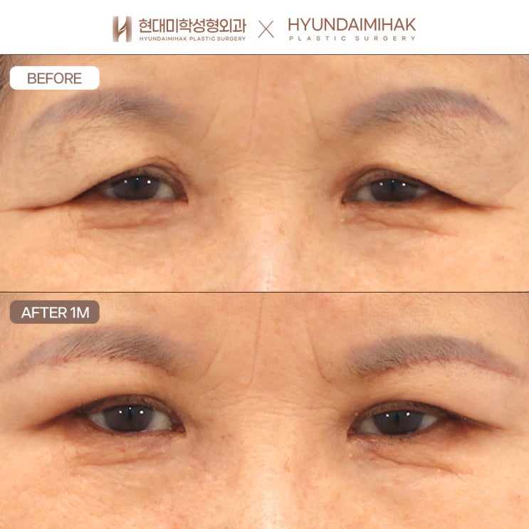 ศัลยกรรมยกคิ้วเพื่อคงภาพลักษณ์ที่ดูอ่อนเยาว์