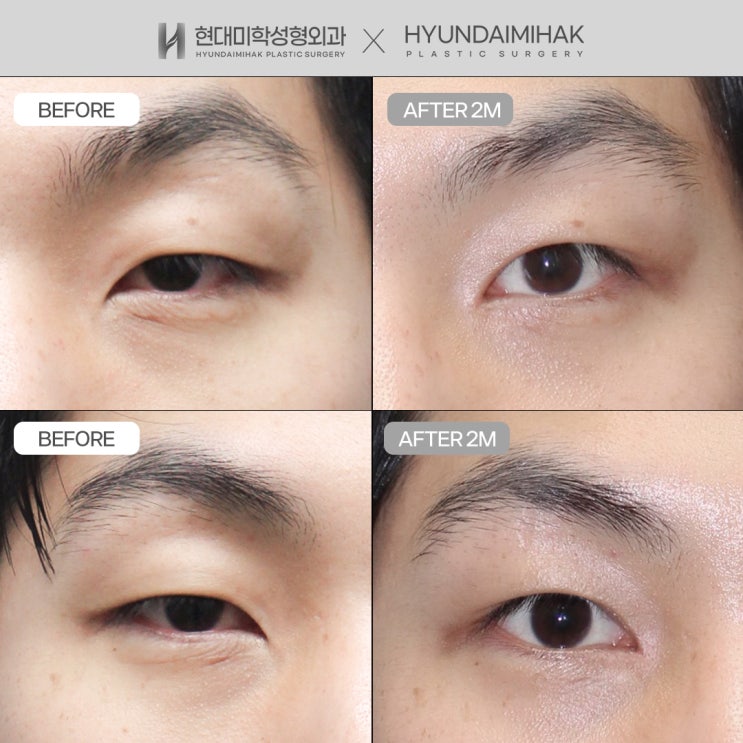 ศัลยกรรมแก้ไขหัวตาสำหรับผู้ชาย แก้หัวตาทรงตะขอที่ทำให้ดูดุ