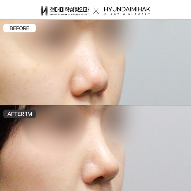 เสริมจมูกด้วยกระดูกอ่อนซี่โครงตนเอง เพื่อการผ่าตัดที่มั่นคงและปลอดภัย