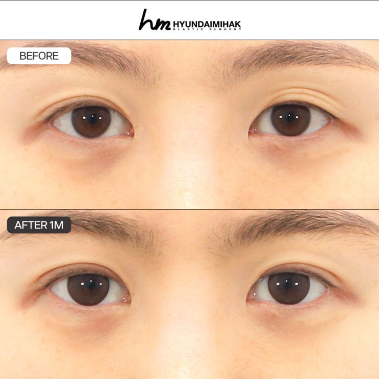 FAQ การแก้ตาสองชั้นแบบกรีด │ โปรดอ่านก่อนตัดสินใจผ่าตัดแก้ไข