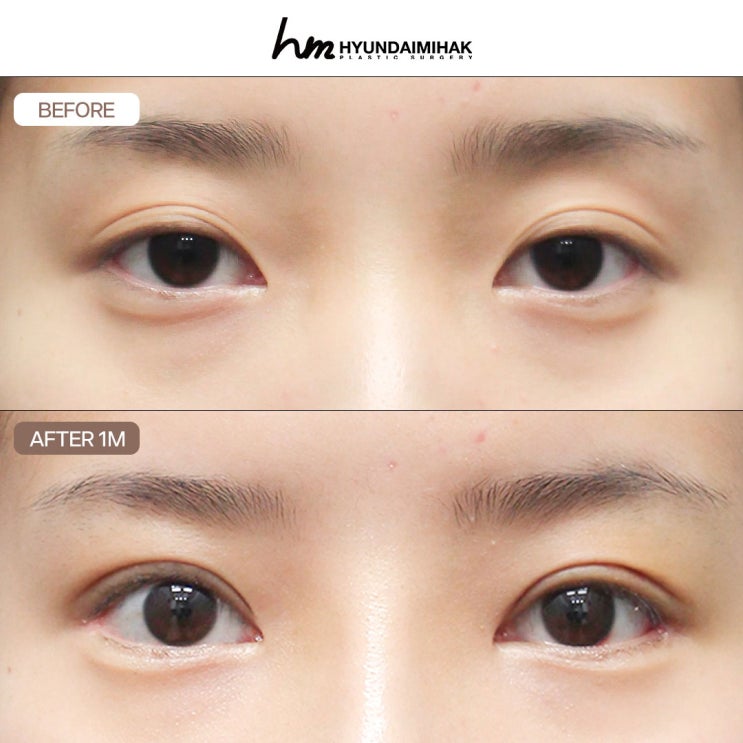 6 เรื่องที่คนอยากรู้มากที่สุดเกี่ยวกับการทำตาสองชั้นแบบเย็บจุด