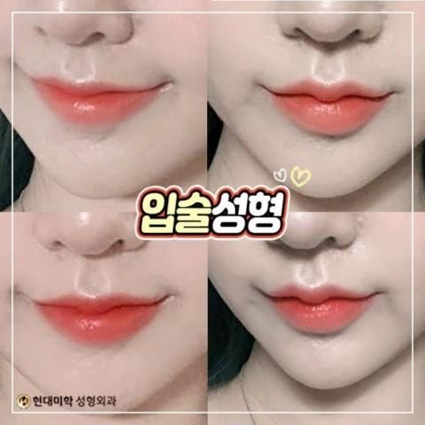 ศัลยกรรมแก้ไขริมฝีปากไม่สมมาตร เมื่อปรับให้สมดุลแล้วจะดูสวยขึ้น