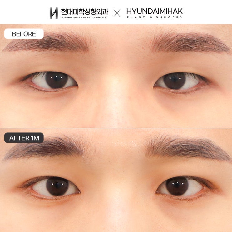 ค่าใช้จ่ายในการแก้ไขกล้ามเนื้อตาสำหรับผู้ชายให้อยู่ในระดับที่เหมาะสม