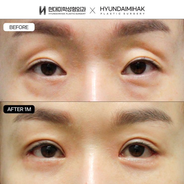 ปรับรูปตาด้วยการเปิดหัวตาร่วมกับทำตาสองชั้น