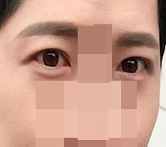 รีวิวทำตาสองชั้นของผู้ชาย ㅋㅋㅋ