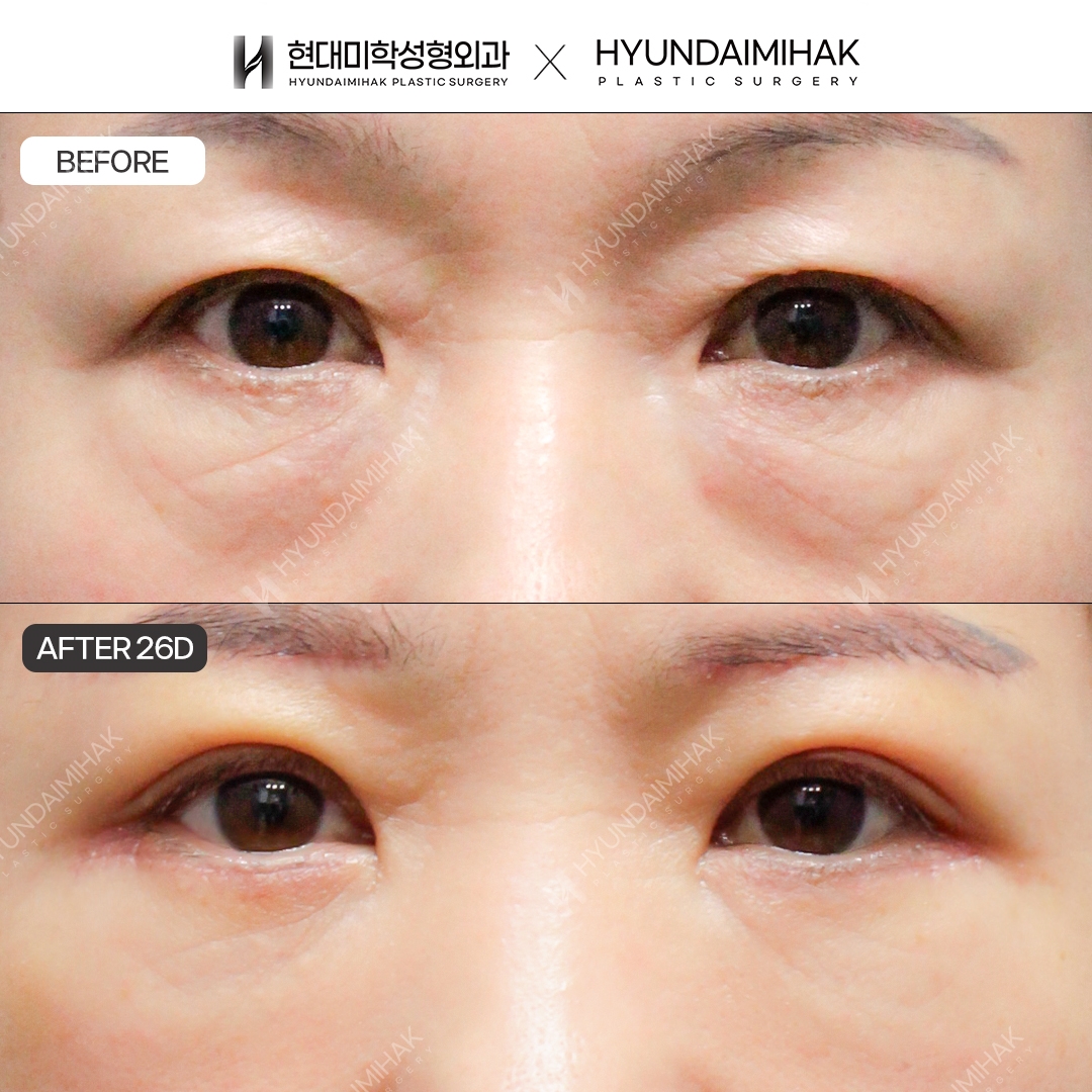 [ศัลยกรรมตาวัยกลางคน] หนังตาบน + หนังตาล่าง + จัดเรียงไขมันใต้ตา