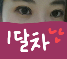 เอารูปก่อนหลังแก้กล้ามเนื้อตาและกรีดตาสองชั้นมาฝากค่ะ~^^