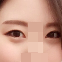 เพอร์เฟกต์บิ๊กอายพร้อมผ่าตัดหางตาเพิ่ม!