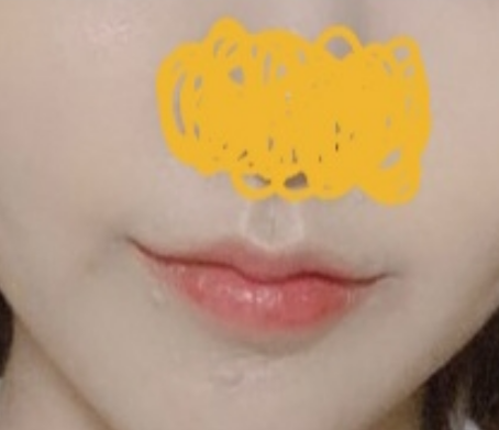 ผ่าตัดมุมปากสำเร็จ >_<