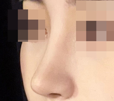 I recommend Hyundai Thailand to anyone who wants pretty nose surgery!!!!!