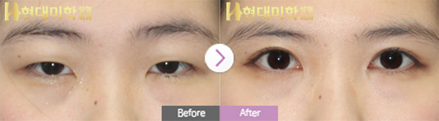 วิธีกรีด, ปรับกล้ามเนื้อตา, เปิดหัวตา