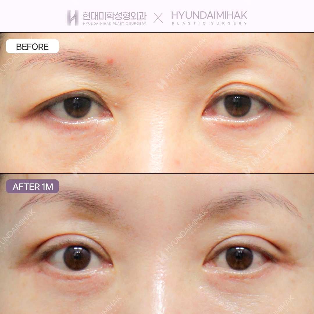 [แก้ตาไม่เท่ากัน] กรีดทำตาสองชั้น + แก้กล้ามเนื้อตา + หนังตาล่าง
