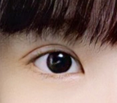 วันที่ 10 หลังแก้ตาสองชั้น รู้สึกออกมาดีมาก พอใจมากเลย